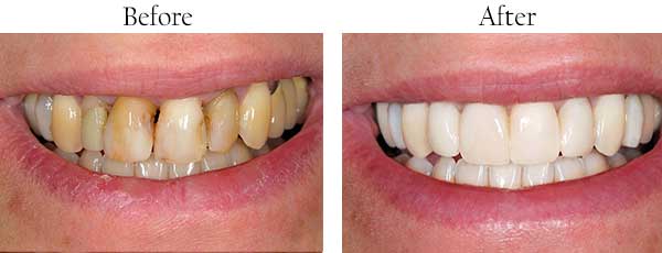 St James Before and After Teeth Whitening