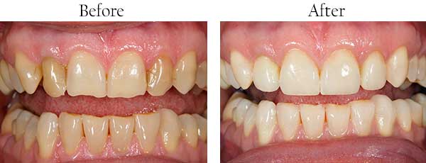Nesconset Before and After Invisalign